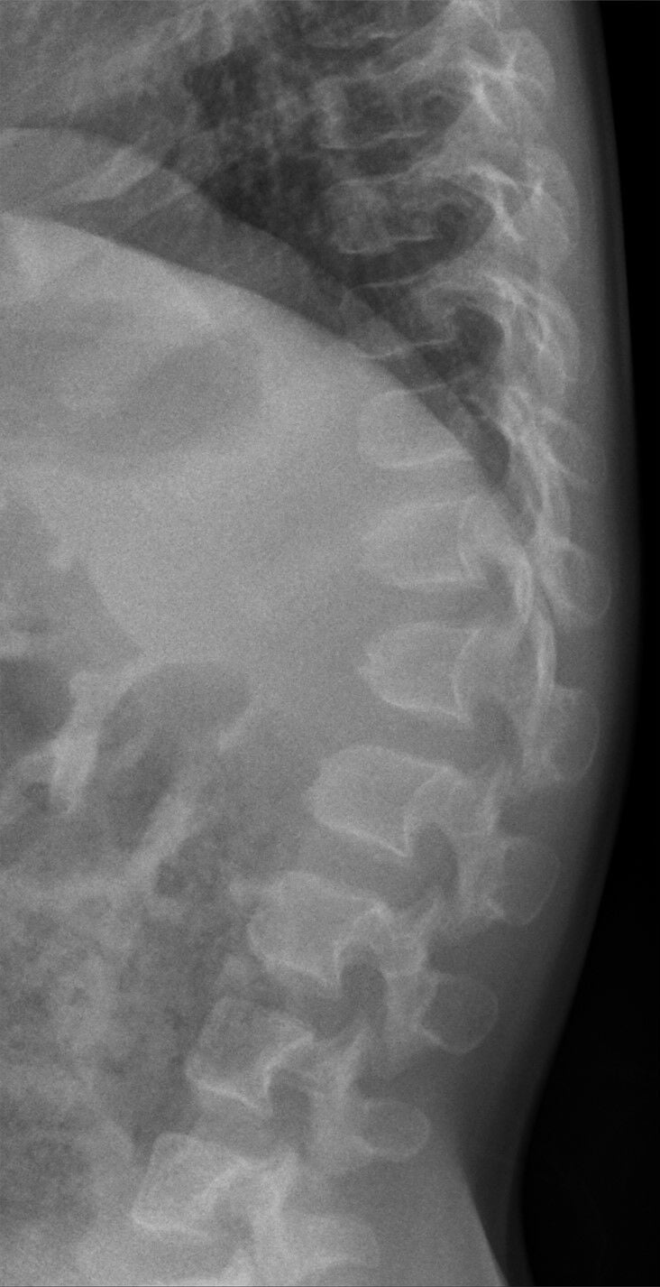Lateral thoracolumbar spine radiograph in achondroplasia.