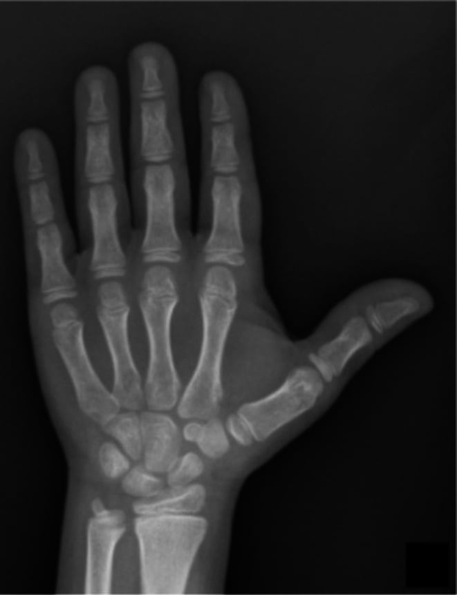 Hand radiograph showing short tubular bones and trident hand configuration