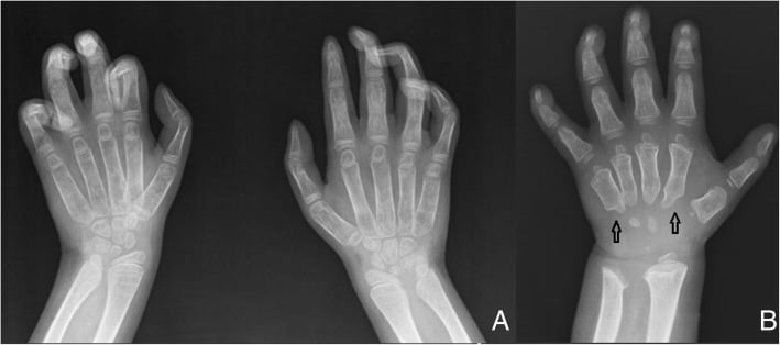 Hand radiographs demonstrating claw hand deformity and dysostosis multiplex