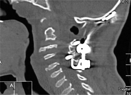 Sagittal 3D CT of cervical spine showing occipitocervical fusion for C1-C2 instability in MPS IV A