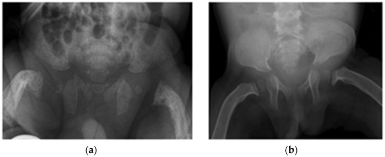 Pelvic radiograph showing dysostosis multiplex changes and pelvic deformities