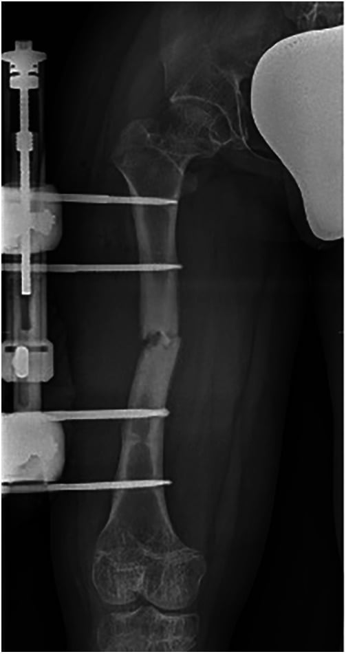 Radiograph of femur during diaphyseal lengthening with external fixator