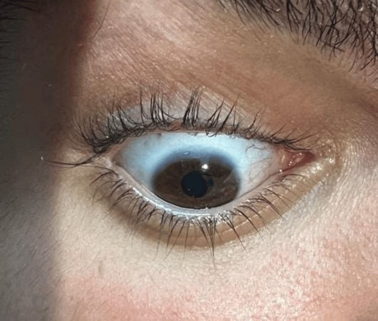 Clinical photograph demonstrating blue sclera in osteogenesis imperfecta
