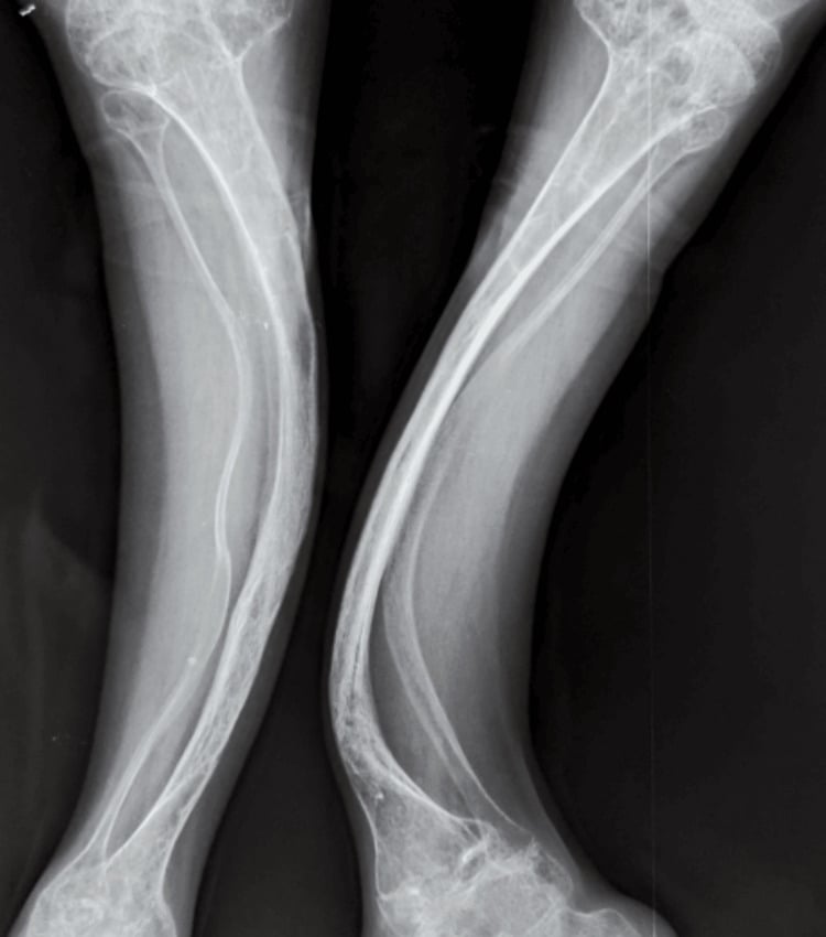 Radiographs of both tibias showing saber-blade bowing deformities