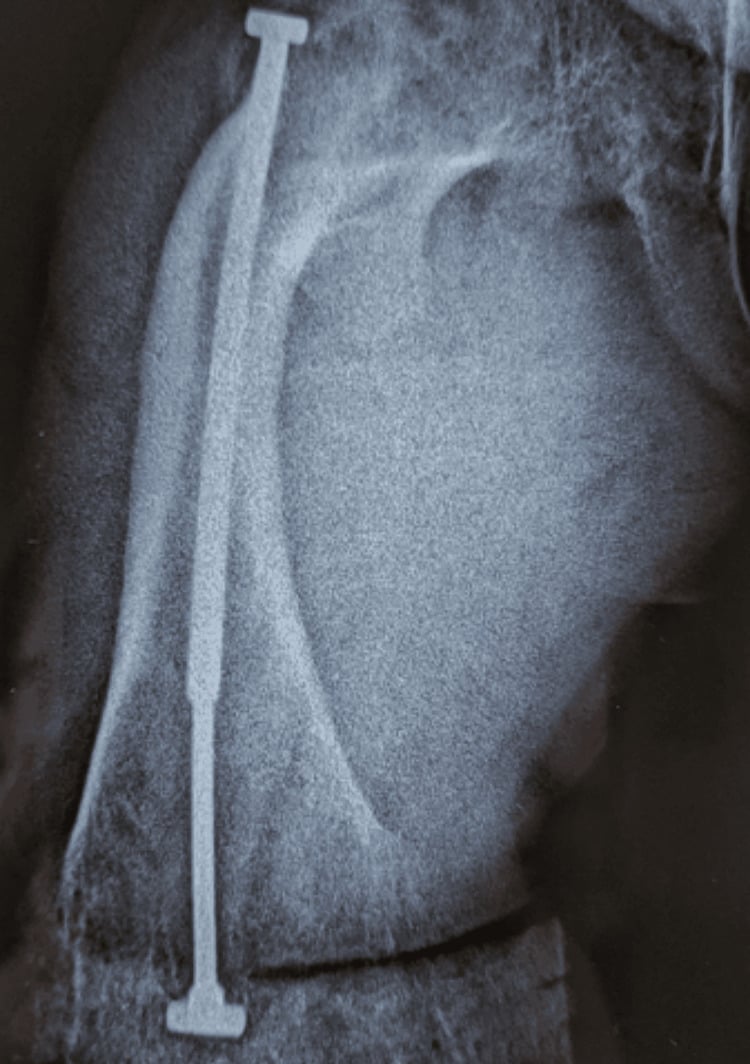 Radiograph showing femoral intramedullary rodding with epiphyseal fixation