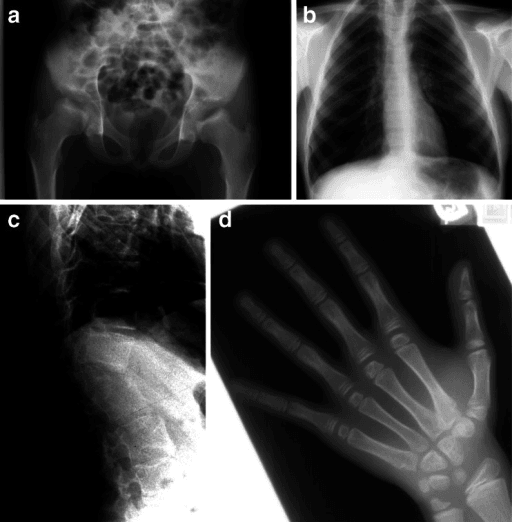 Radiographic series showing dysostosis multiplex features in Morquio A syndrome