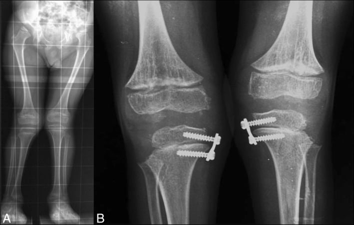 Radiographs showing bilateral genu valgum managed with guided growth plates in Hurler syndrome