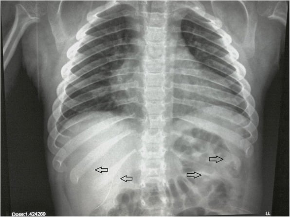 Chest radiograph highlighting paddle-shaped ribs in Morquio syndrome