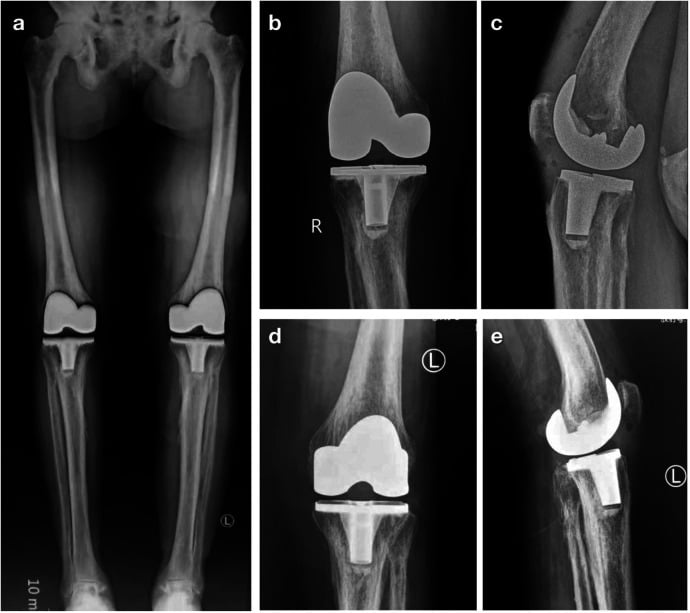 Postoperative full-length radiographs following bilateral total knee arthroplasty in skeletal fluorosis