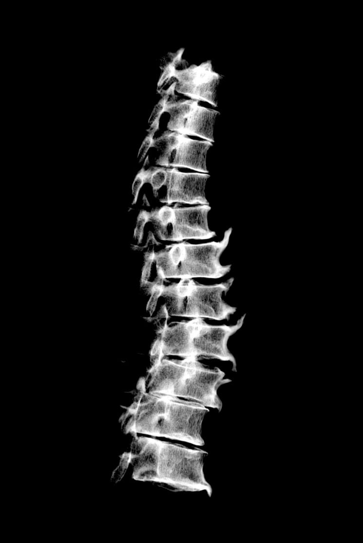 Lateral radiograph of thoracic spine showing anterior longitudinal ligament ossification in skeletal fluorosis