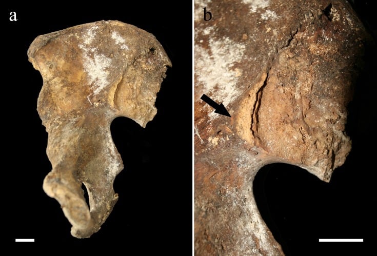 Pelvic bone anatomical specimen showing sacroiliac joint bony bridging in skeletal fluorosis