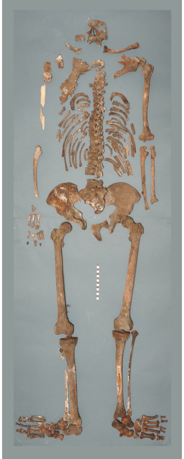 Full skeletal remains specimen demonstrating generalized diffuse osteosclerosis