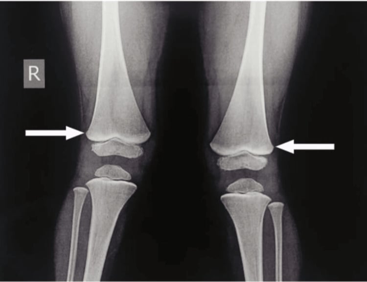 AP knee radiograph demonstrating dense transverse metaphyseal lead lines in lead poisoning
