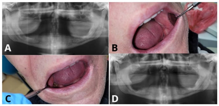 Panoramic dental radiograph demonstrating medication-related osteonecrosis of the jaw