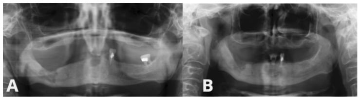 Panoramic dental radiographs showing MRONJ lesion before and after surgical debridement