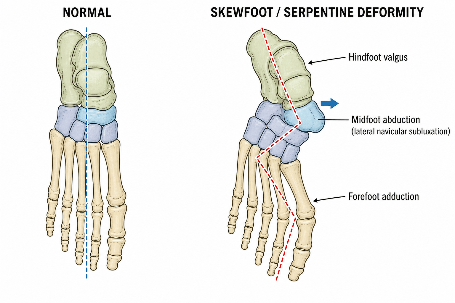 Dorsal view comparison of a normal foot skeleton and the skewfoot Z-deformity, showing hindfoot valgus, midfoot abduction with lateral navicular subluxation, and forefoot adduction
