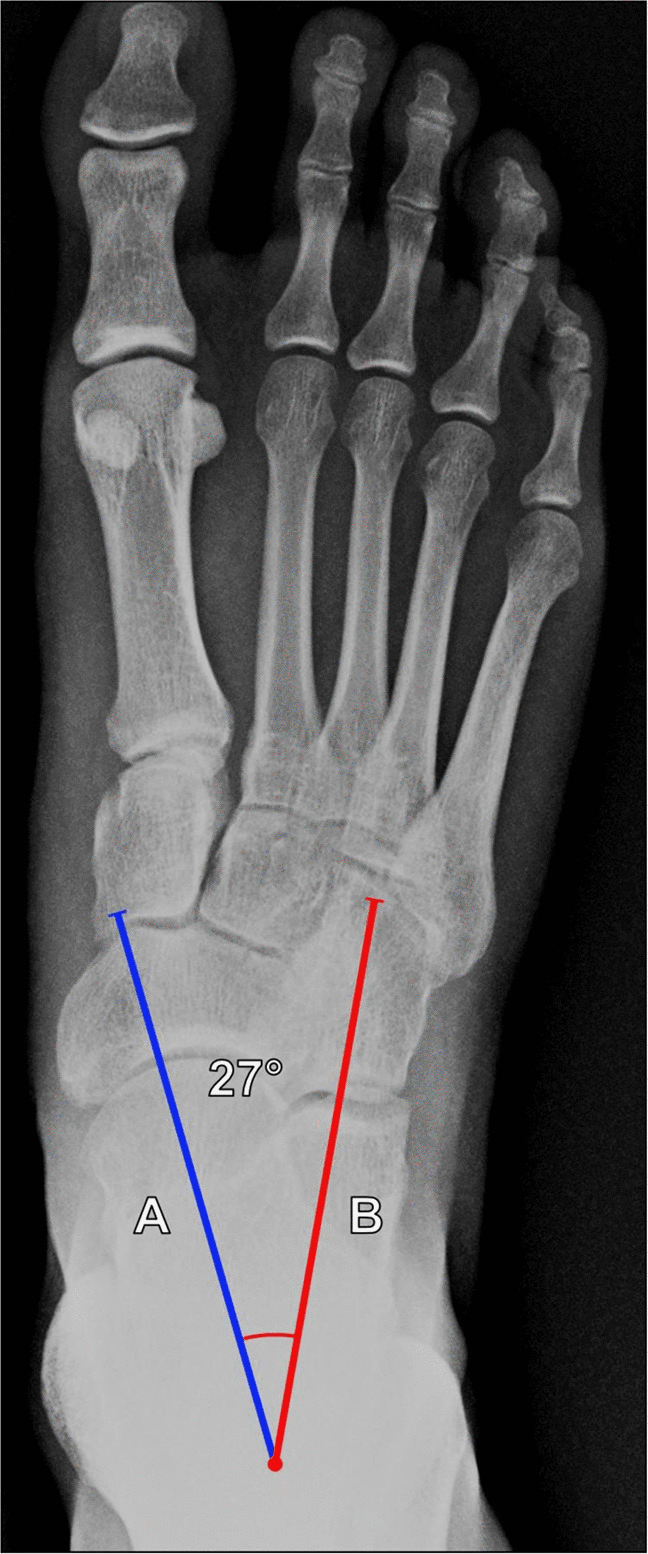 Weight-bearing dorsoplantar foot radiograph showing AP talocalcaneal Kite angle