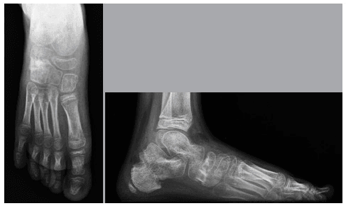 Postoperative AP and lateral foot radiographs after calcaneal and cuboid osteotomies