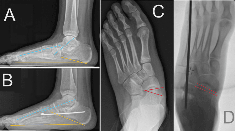 Standing preoperative postoperative and intraoperative images measuring Meary pitch and talonavicular coverage after calcaneal lengthening