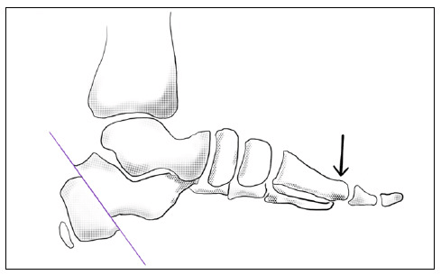 Lateral line drawing showing how calcaneal osteotomy changes Meary alignment