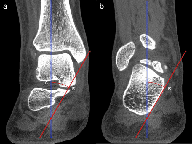 Coronal weight-bearing cone-beam CT showing tibiocalcaneal hindfoot valgus angle