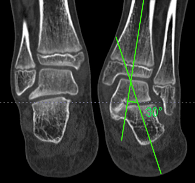 Coronal cone-beam CT comparing normal hindfoot with valgus caused by talocalcaneal coalition