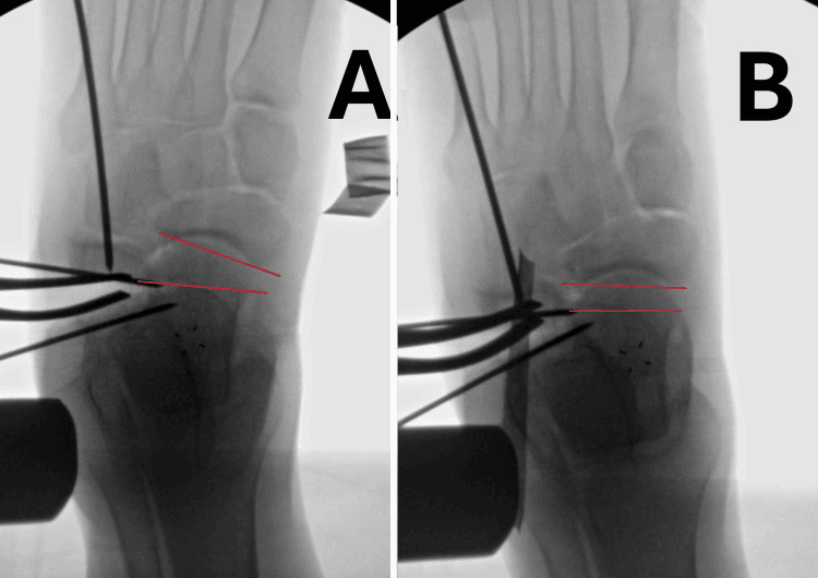 Intraoperative fluoroscopic images before and after stress showing talonavicular coverage during calcaneal lengthening