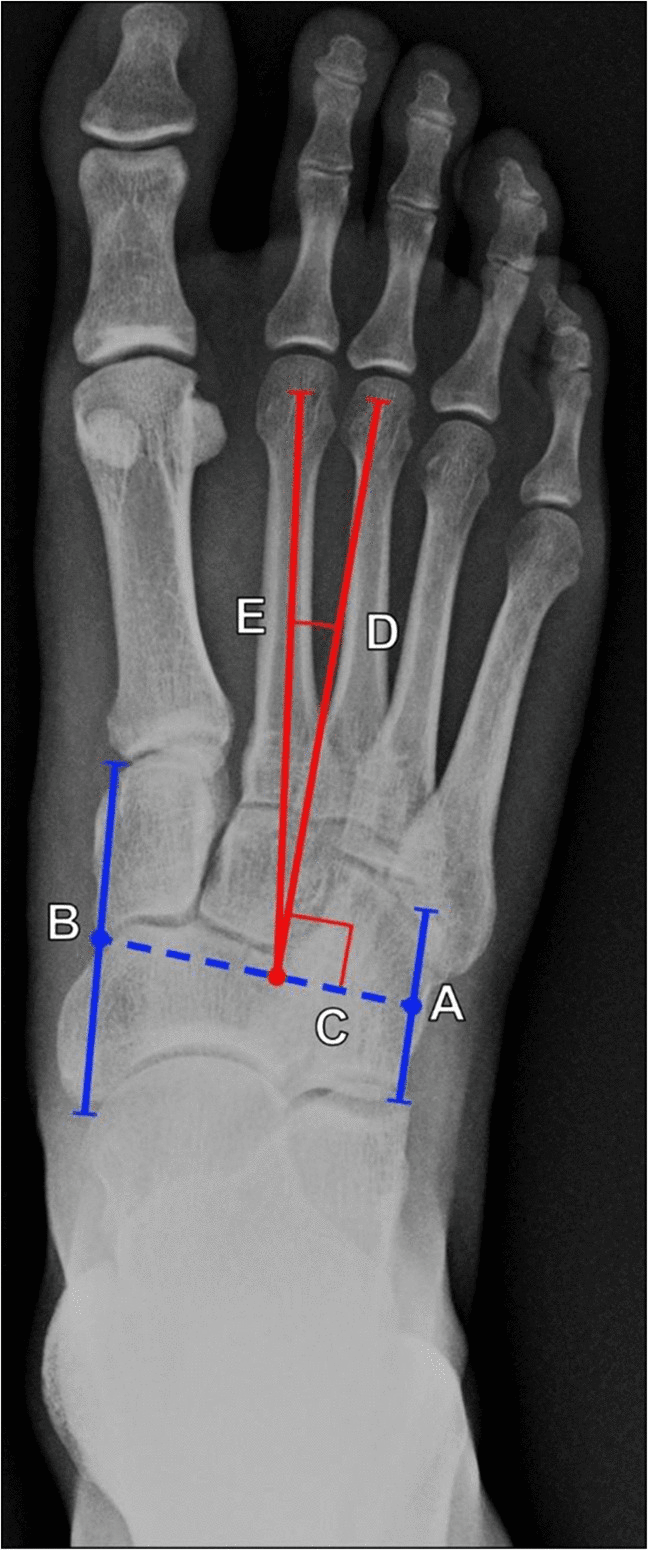 Weight-bearing dorsoplantar foot radiograph showing Sgarlato metatarsus adductus angle construction