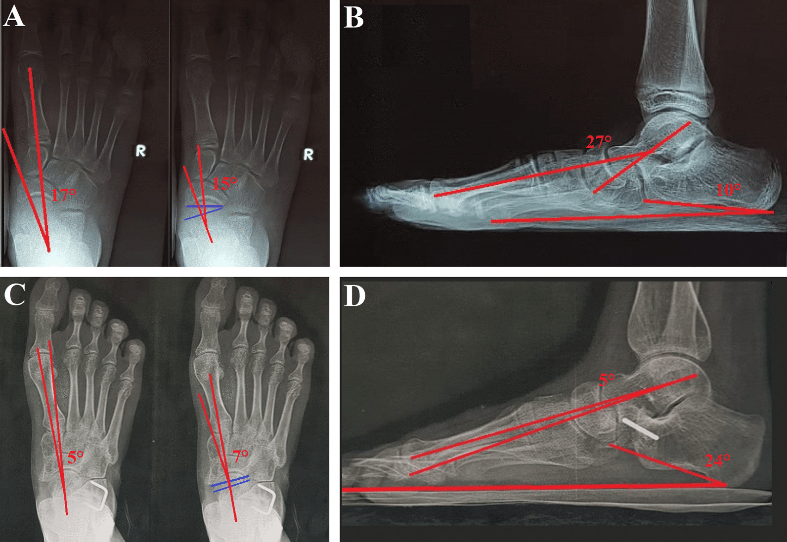 Weight-bearing AP and lateral paediatric foot radiographs before and after calcaneal lengthening reconstruction