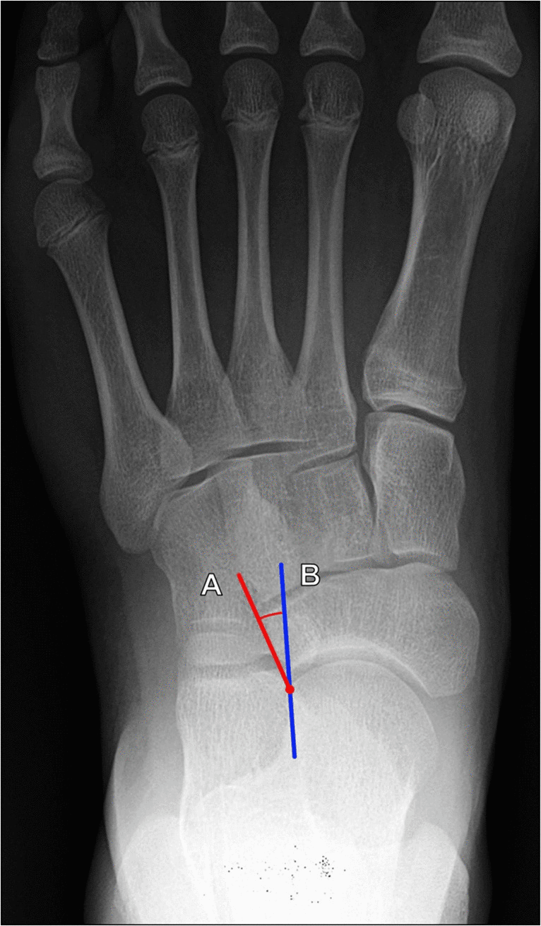 Weight-bearing dorsoplantar foot radiograph showing talonavicular incongruency angle measurement