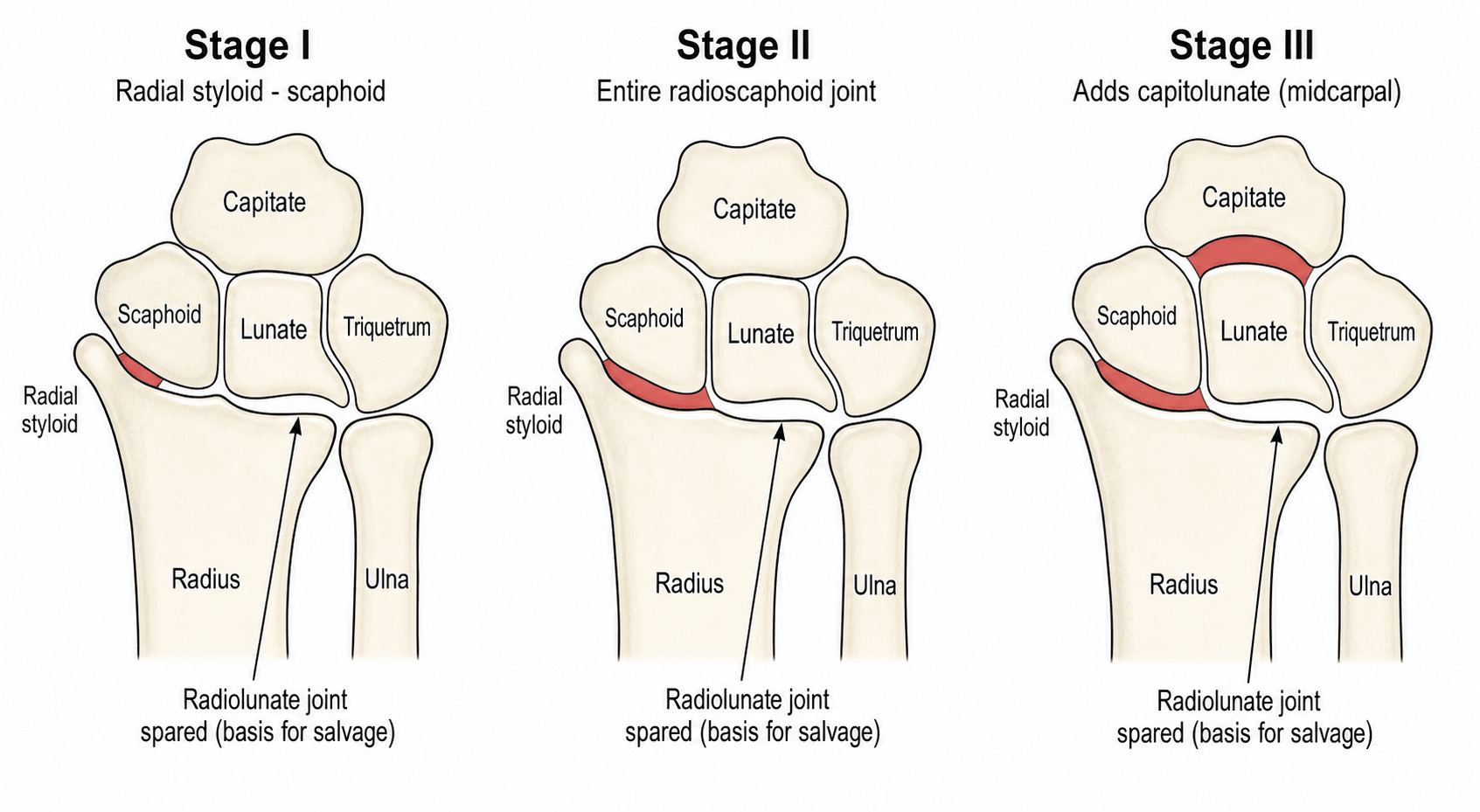 Diagram of the SLAC wrist stages I to III showing the arthritic joints and the spared radiolunate joint.