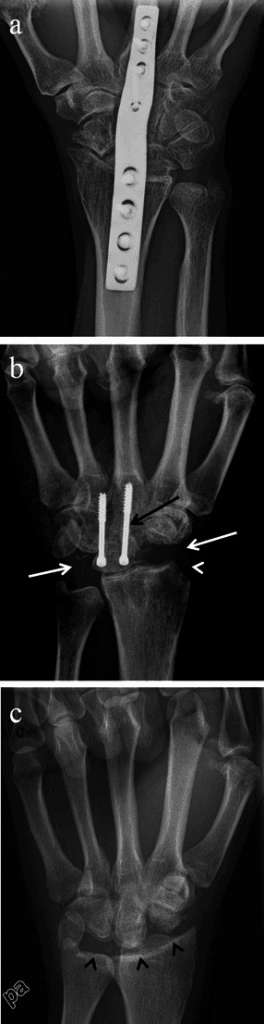 Three surgical options for SLAC wrist: total wrist fusion, four-corner fusion, and proximal row carpectomy
