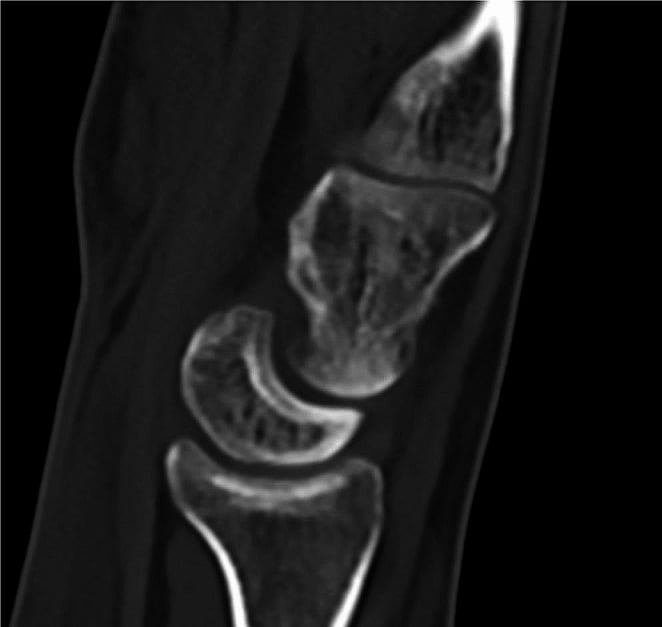 Sagittal CT of the wrist showing established osteoarthritic change with dorsal intercalated segment instability alignment