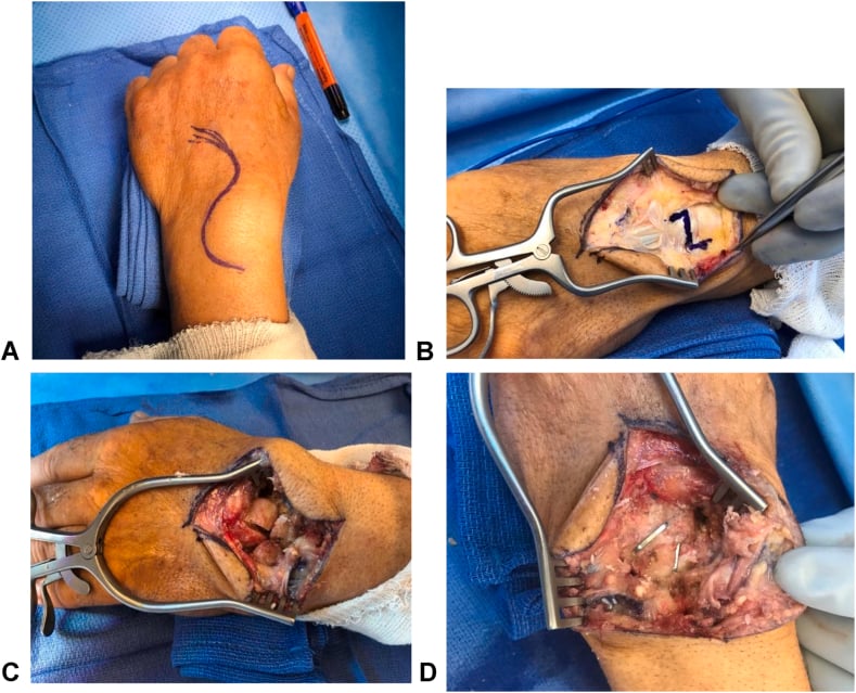 Surgical technique photographs showing marking for a modified dorsal wrist approach, extensor retinaculum Z-plasty and exposure of the carpus