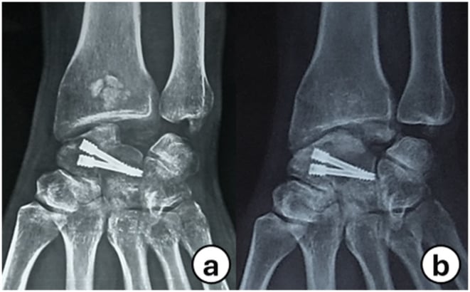 Postoperative anteroposterior and lateral wrist radiographs four months after scaphoid excision and capitolunate fusion with headless screws and bone graft