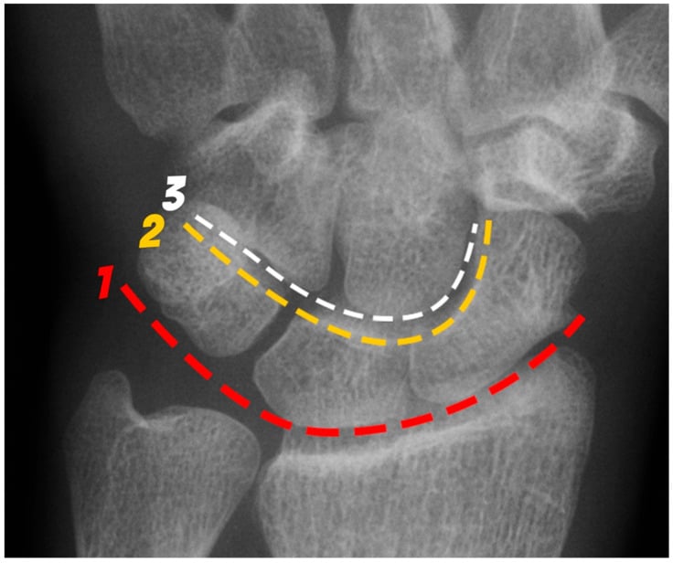 Posteroanterior wrist radiograph with the three arcs of Gilula drawn in red, yellow and white along the proximal and distal carpal surfaces