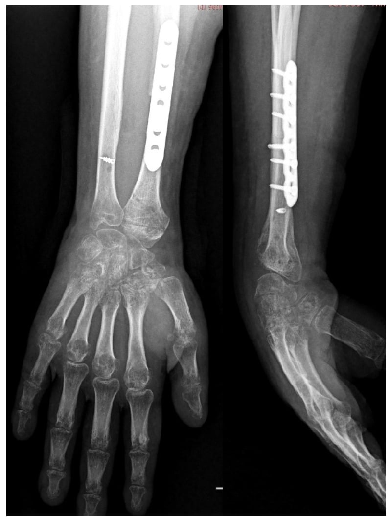Three-month postoperative anteroposterior and lateral wrist radiographs after Kirschner wire removal