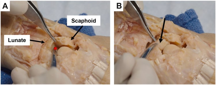 Intraoperative photographs labelling the scaphoid and lunate with the interval between them and a Kirschner wire directed into the lunate
