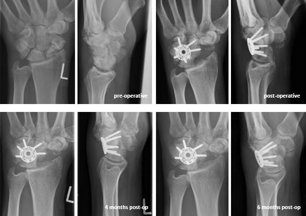 Serial radiograph series of an advanced carpal collapse treated with a variable angle locking plate showing preoperative, postoperative, three-month and six-month appearances