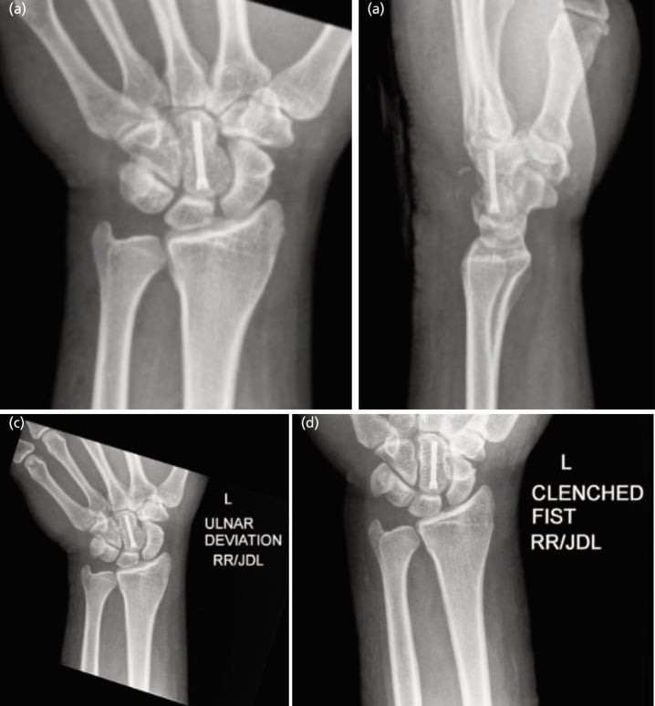 Posteroanterior, lateral, ulnar deviation and clenched fist radiographs of the wrist confirming carpal alignment