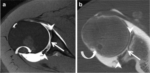 Axial MR arthrography and matched CT arthrography of the shoulder showing a global (circumferential) labral tear.