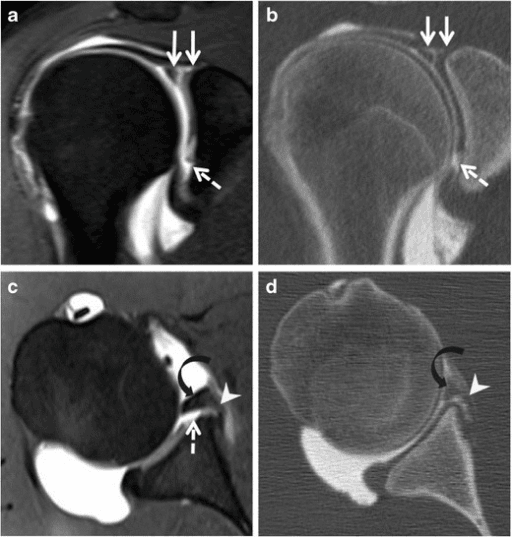Coronal and axial MR and CT arthrography showing a bucket-handle superior labral tear with an associated Perthes lesion.