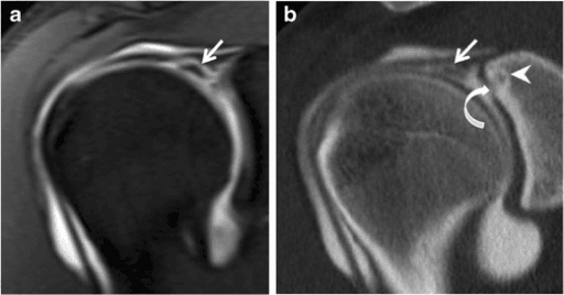 Coronal MR arthrography and matched CT arthrography showing a superior labral tear extending into the biceps anchor.