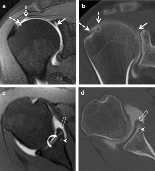 Coronal and axial MR and CT arthrography showing a SLAP tear with anteroinferior labral extension and a rotator cuff lesion.