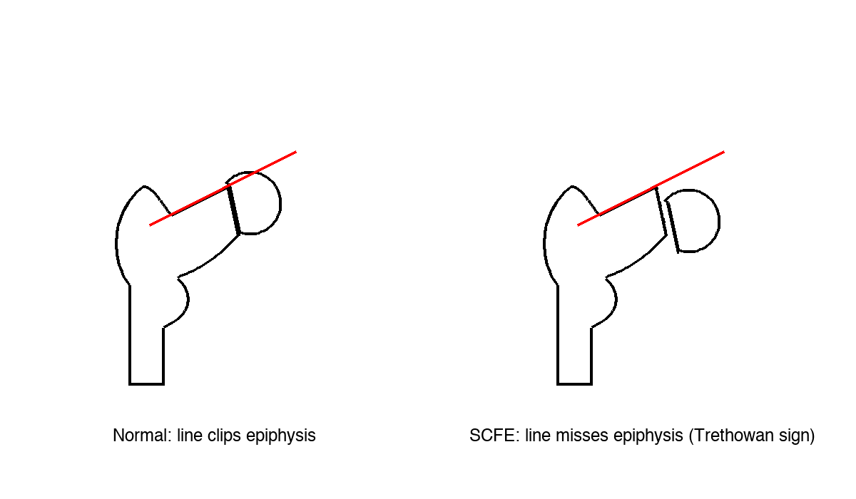 Klein's line and the Trethowan sign in a normal hip versus SCFE