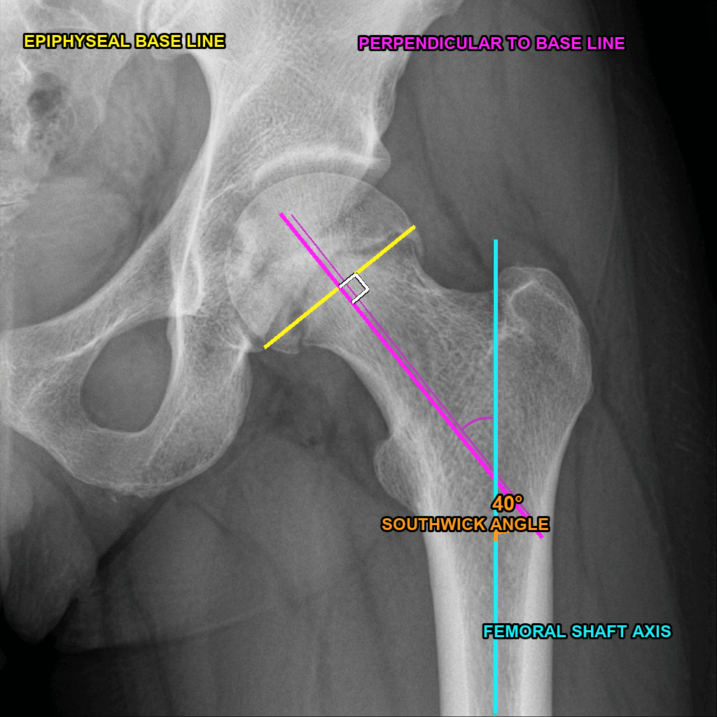 How to measure the Southwick head-shaft slip angle on the proximal femur