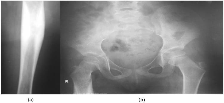 Anteroposterior and lateral radiographs of a femur showing cortical thickening and lamellated periosteal reaction along the diaphysis.
