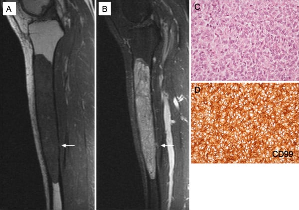 Sagittal T1-weighted and STIR MRI of the tibia showing a well-defined expansile intramedullary lesion confined to bone with surrounding oedema.