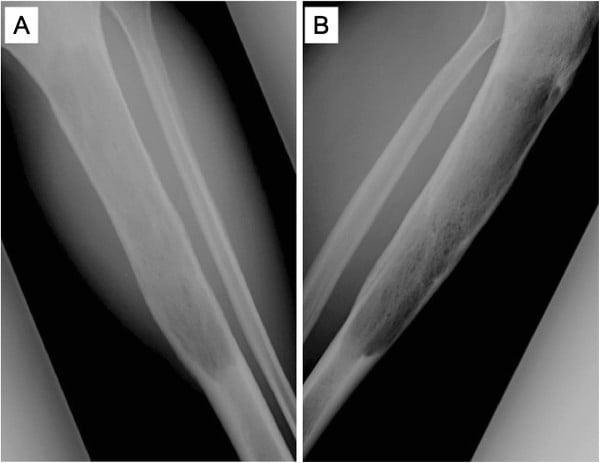 Anteroposterior and lateral radiographs of a tibia showing an expansile permeative lytic lesion of the proximal diaphysis.