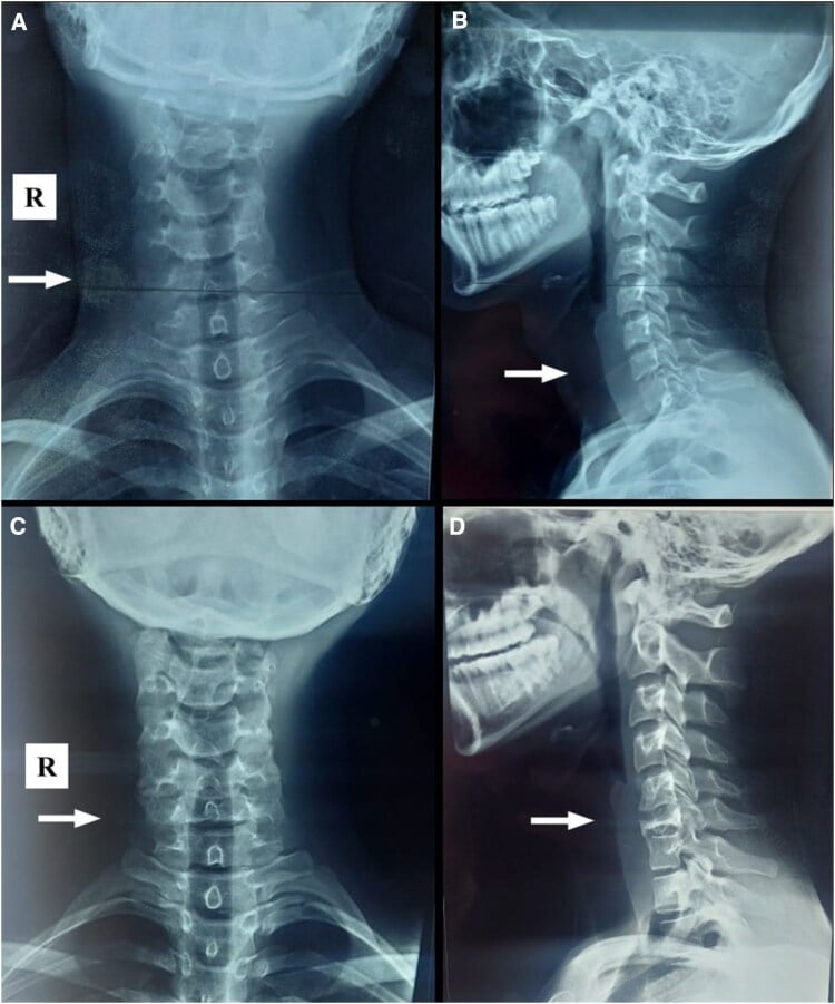 Anteroposterior and lateral cervical radiographs showing collapse of C6 into vertebra plana, with a prior normal film for comparison.